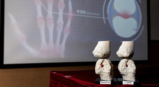 CUHK study reveals breakthrough treatment that can repair and prevent joint damage from psoriatic arthritis