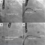 CUHK-PWH team achieves breakthrough in using one single tricuspid catheter to repair both mitral and tricuspid valves for treating severe regurgitation 