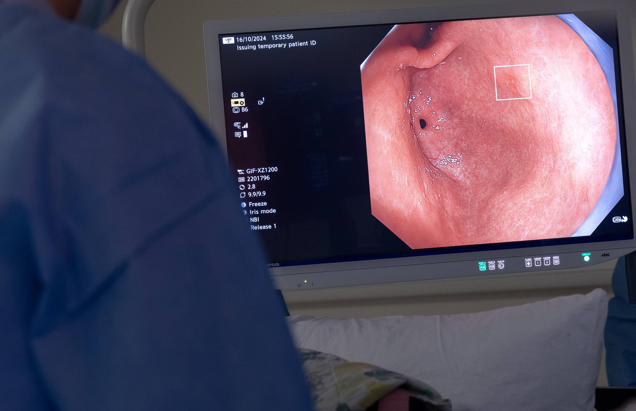 AI powered endoscopy